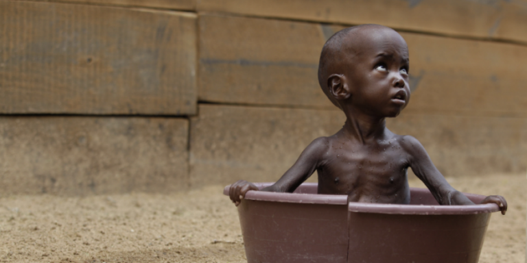 malnutrition